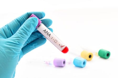 Understanding Your Lab Tests: Antinuclear Antibody Test (ANA) and Autoimmunity