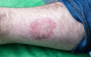 bullseye Lyme Disease rash